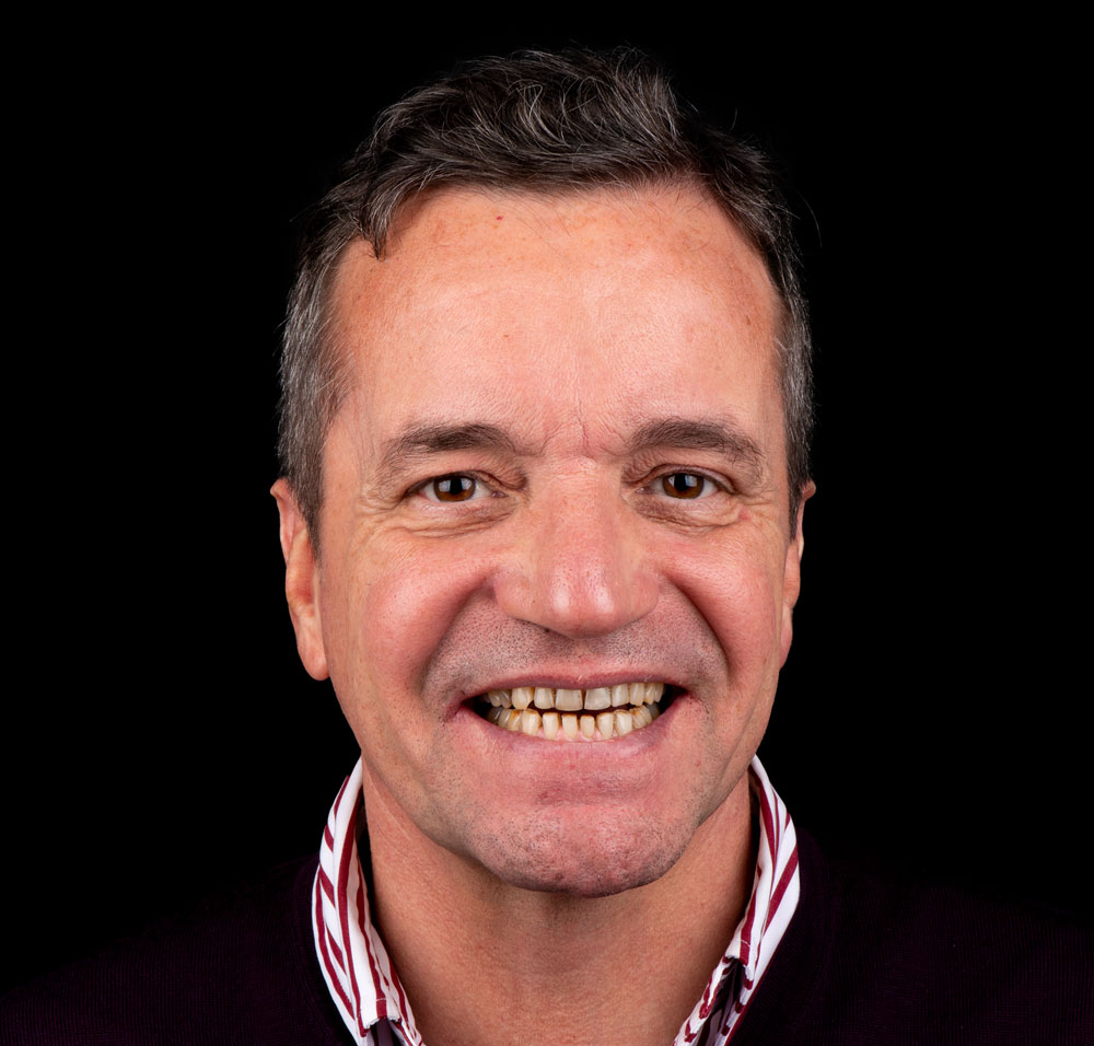 Antes del tratamiento de diseño de sonrisa con carillas dentales