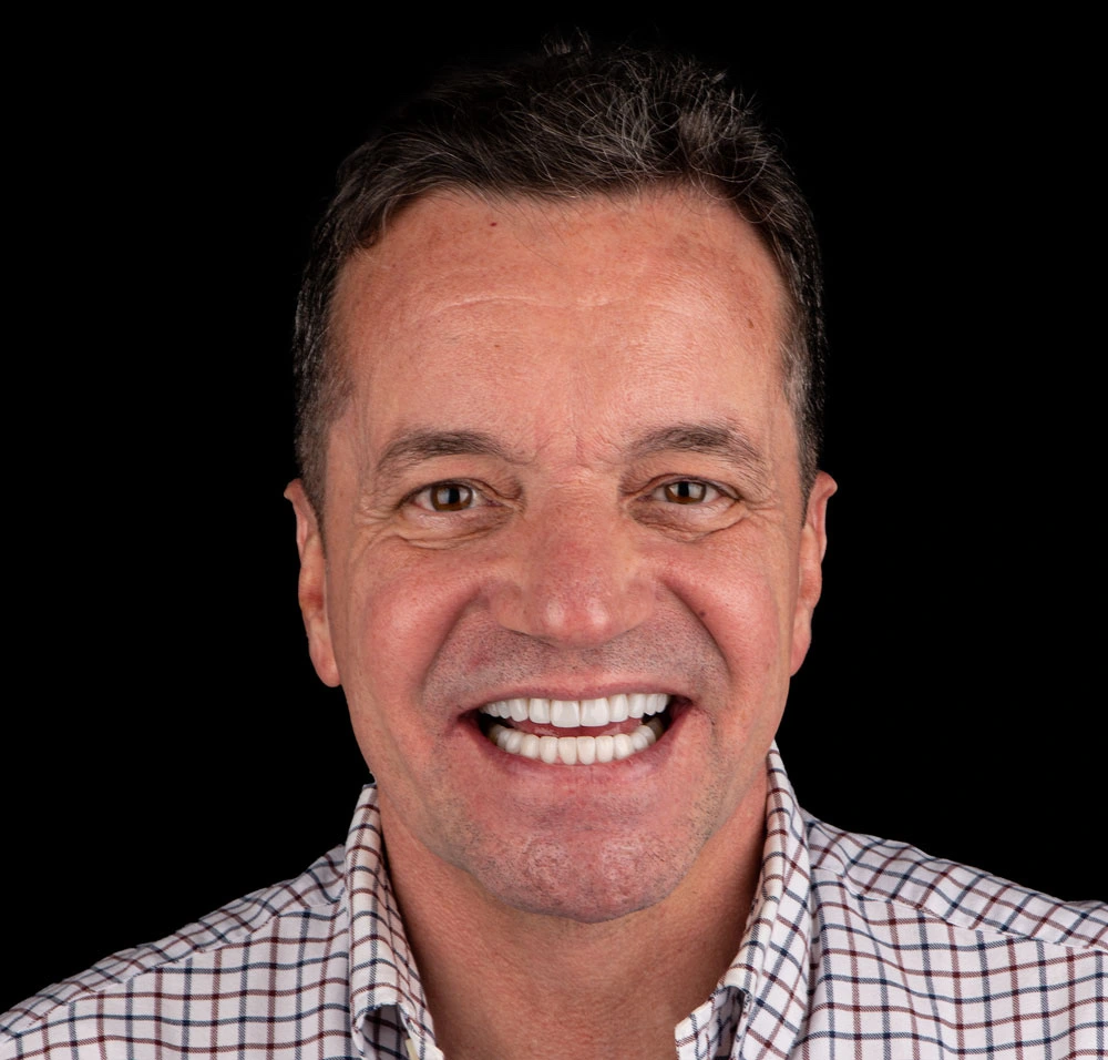 Después del tratamiento de diseño de sonrisa con carillas dentales