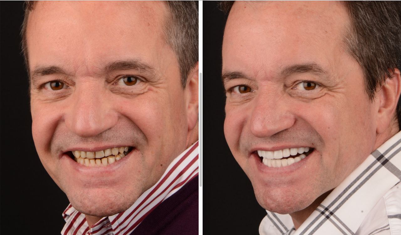 Antes y después de diseño de sonrisa con carillas dentales emax