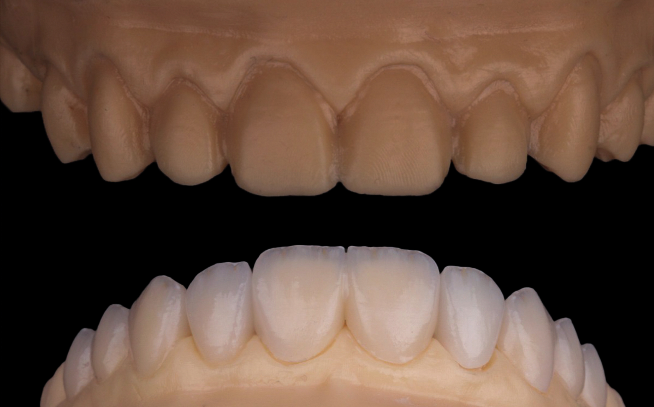 Carillas dentales emax en modelos impresos 3D antes de probar