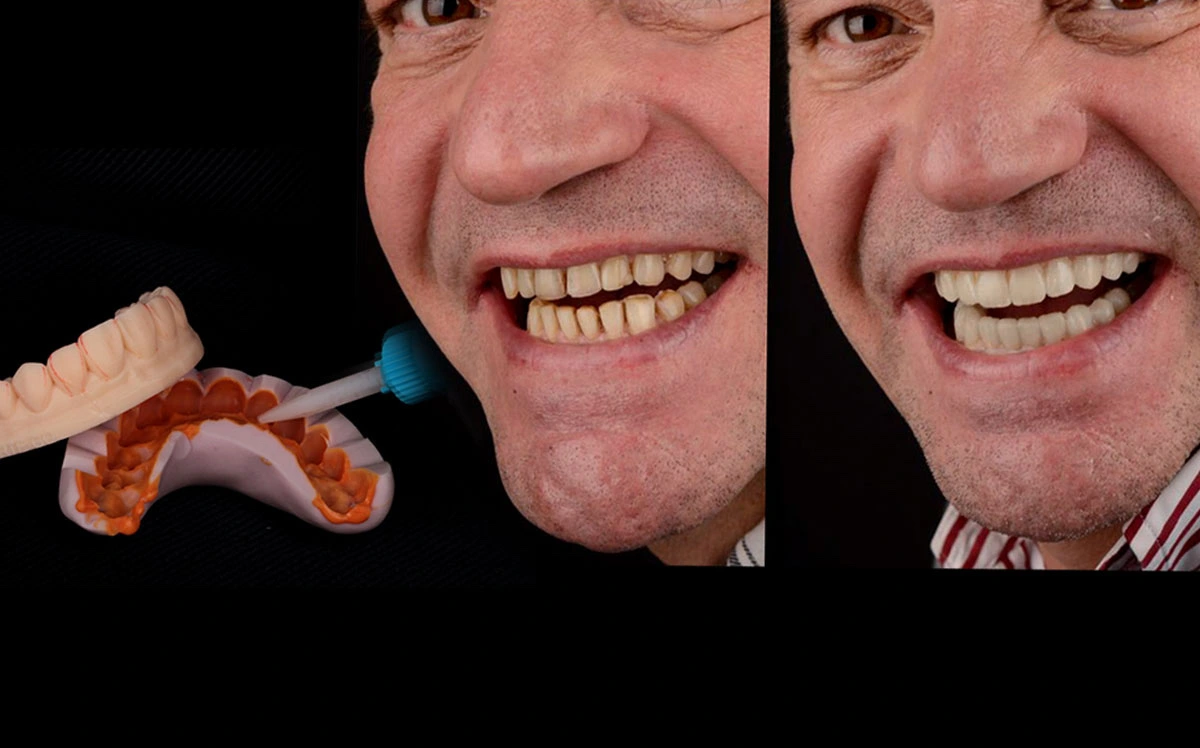 Prueba de diseño de sonrisa maqueta virtual