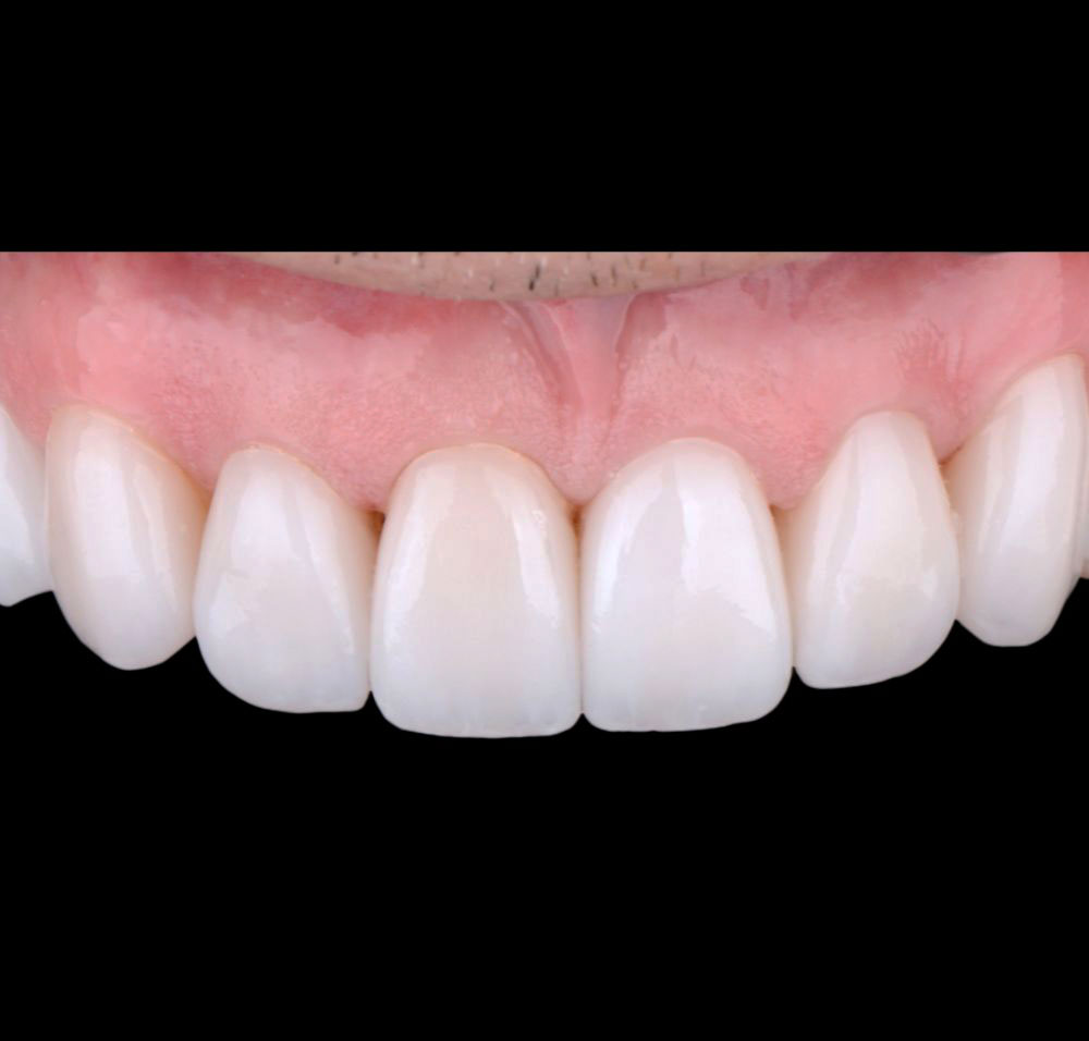 Resultado dental después del tratamiento con carillas dentales