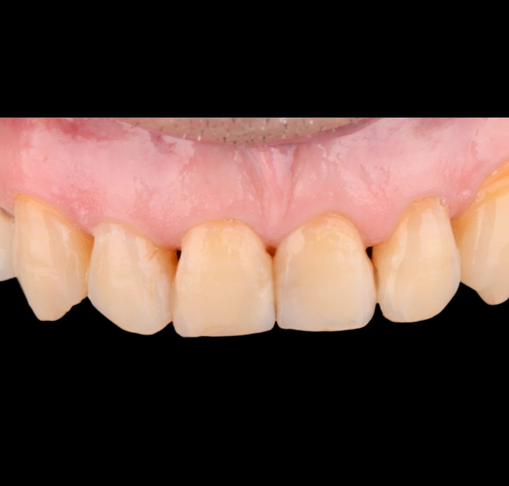 Vista de sonrisa antes del tratamiento con carillas dentales