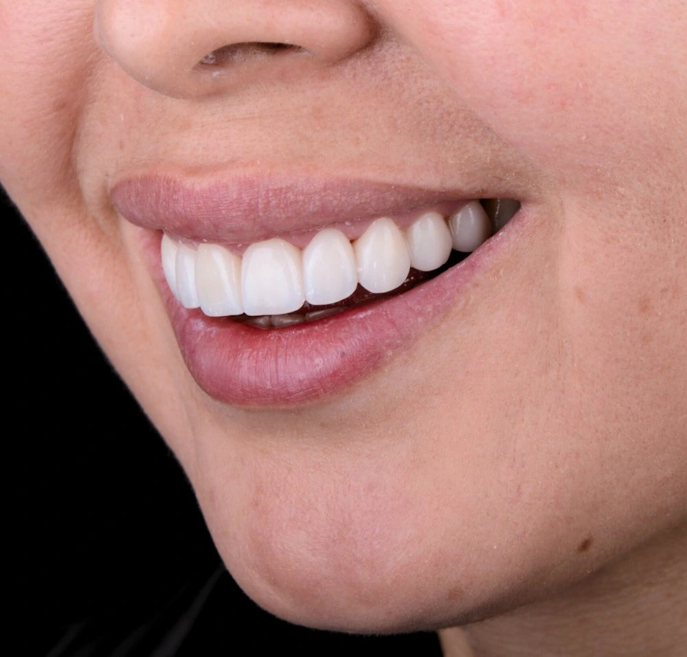 Vista dental después del tratamiento con carillas dentales