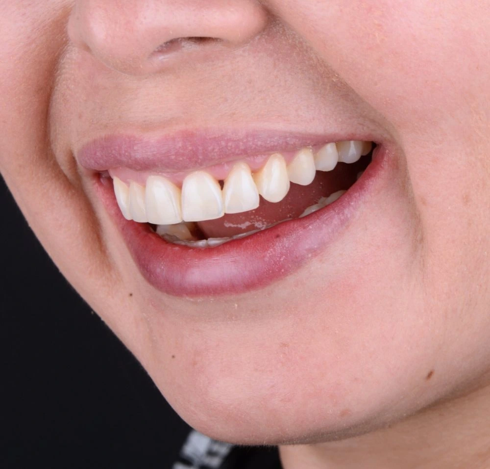 Vista dental antes del tratamiento con carillas dentales