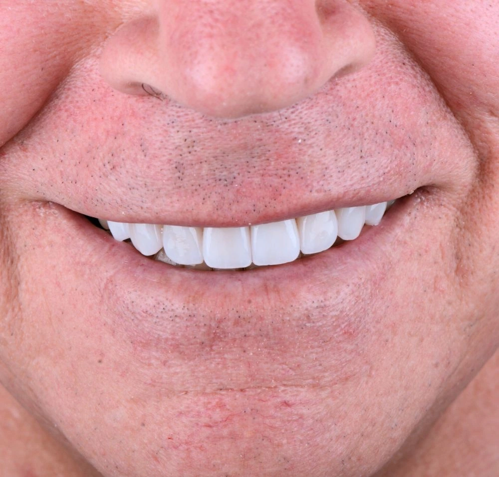 Resultado del tratamiento de diseño de sonrisa con carillas dentales