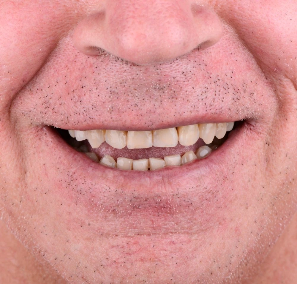 Antes del tratamiento de diseño de sonrisa con carillas dentales