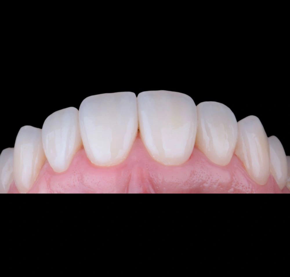Resultado dental después del tratamiento con carillas dentales
