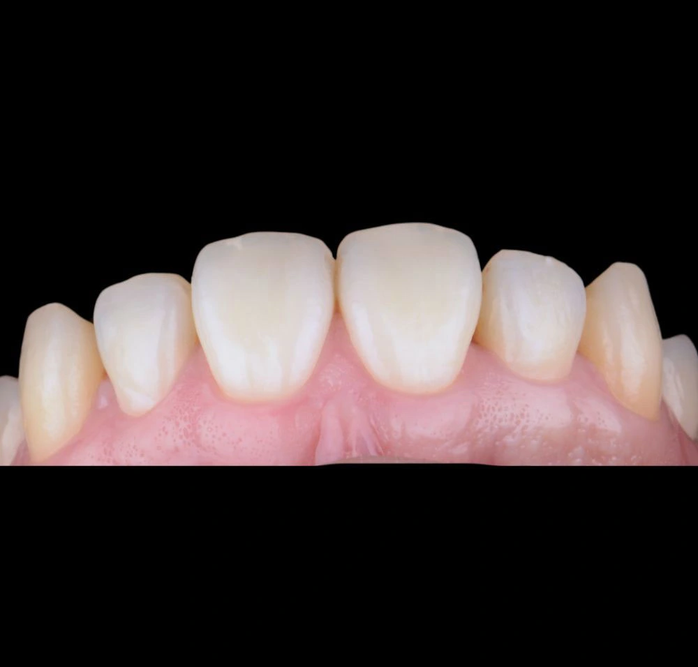 Vista dental antes de tratamiento de carillas dentales
