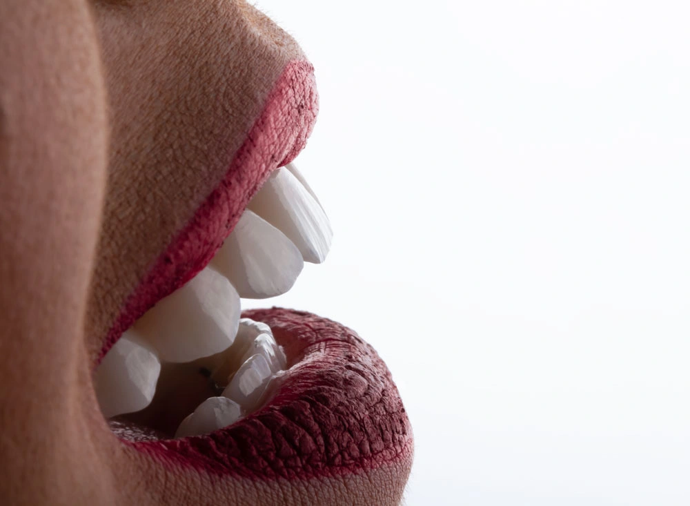 Sonrisa natural con carillas dentales estéticas