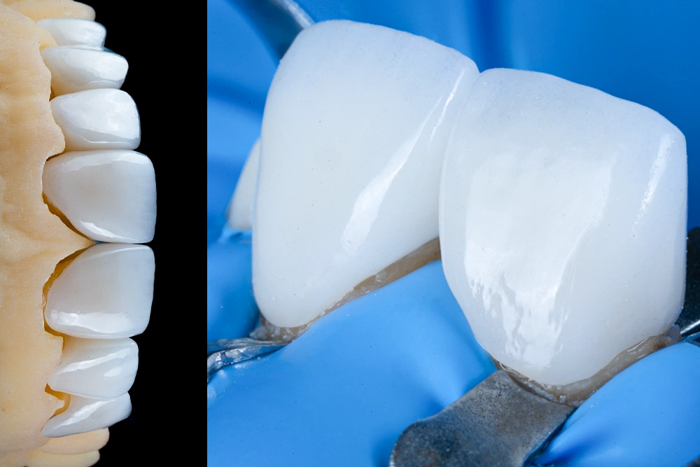 Procedimiento de colocación de carilla dental de porcelana emax de alta estética en diseño de sonrisa