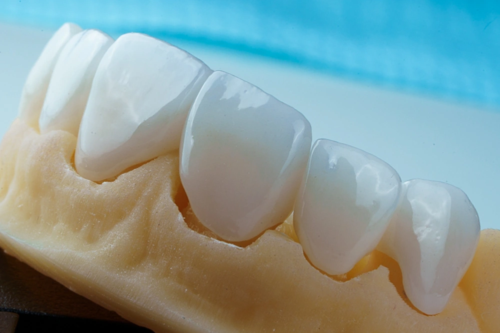 Detalle de carilla dental de porcelana sobre modelo