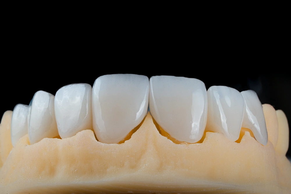 Carillas dentales de porcelana sobre modelo dental