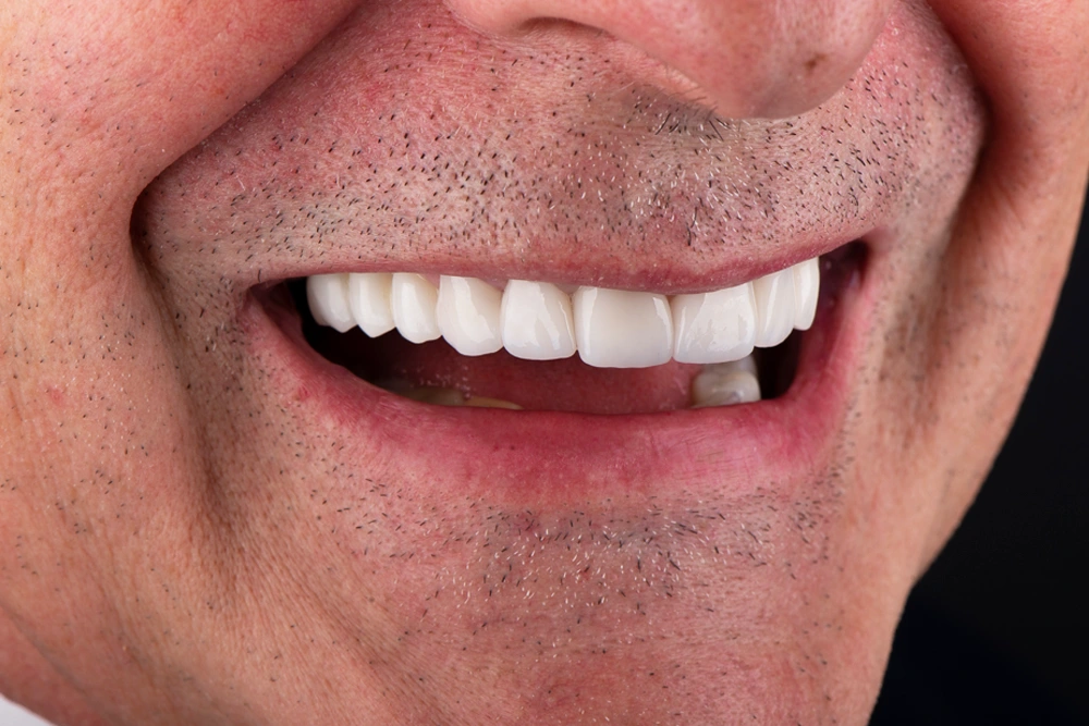 Resultado natural de carillas dentales en vista lateral