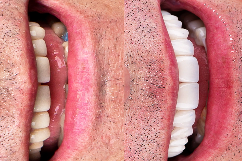 Vista intraoral de tratamiento con carillas dentales