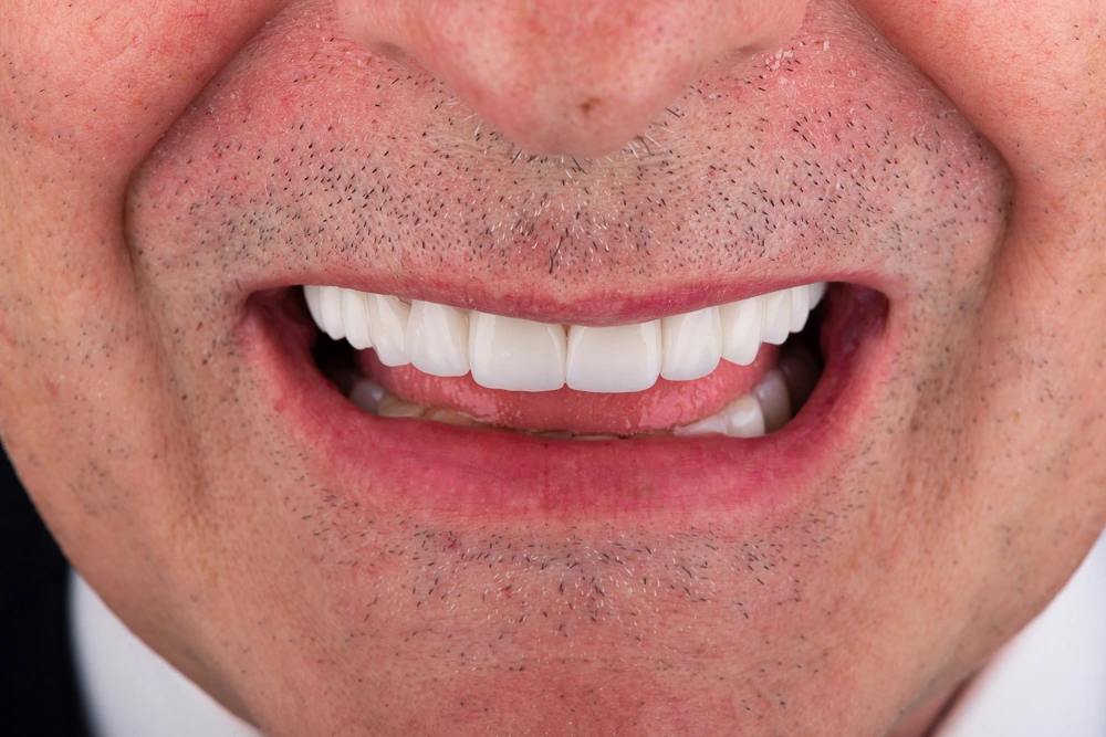 Resultado de diseño de sonrisa con carillas dentales