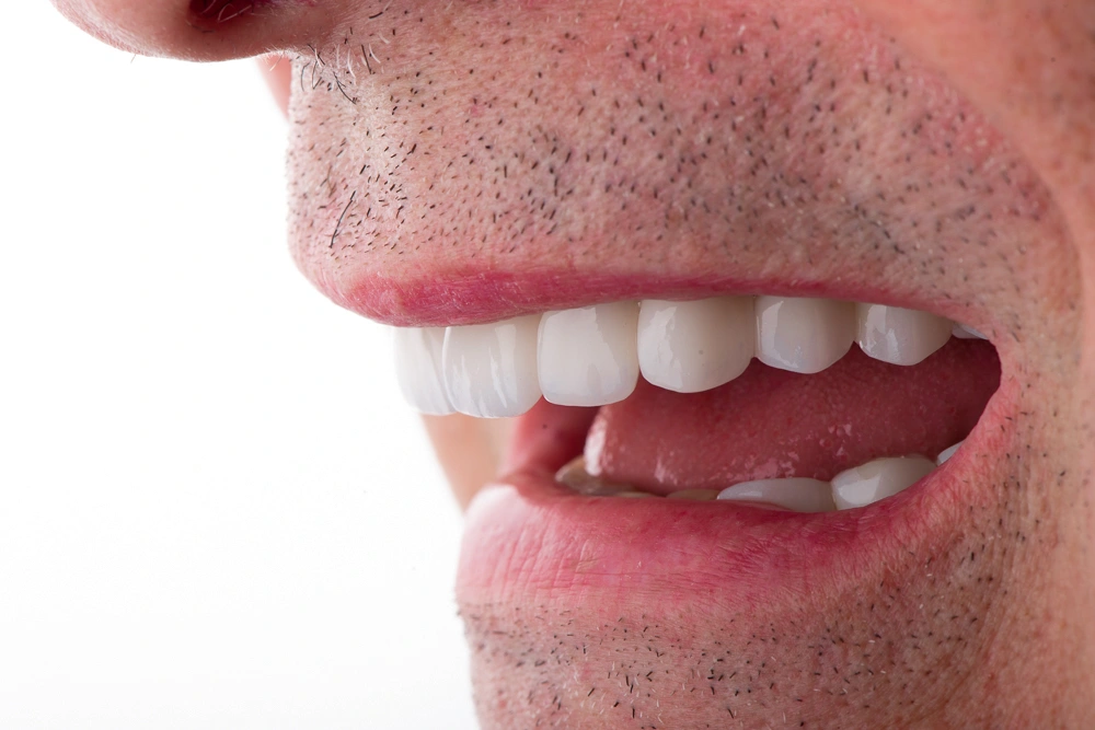 Diseño de sonrisa con carillas dentales visto de perfil