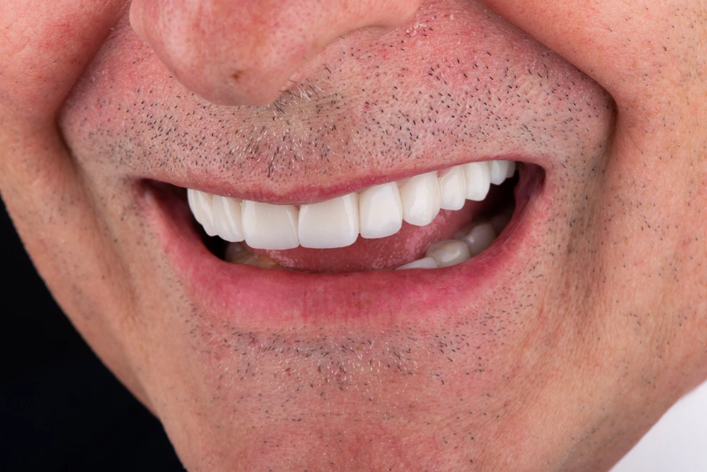 Resultado estético de tratamiento con carillas dentales