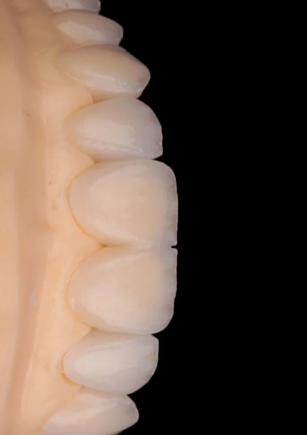 Diseño de carillas dentales sobre modelo dental