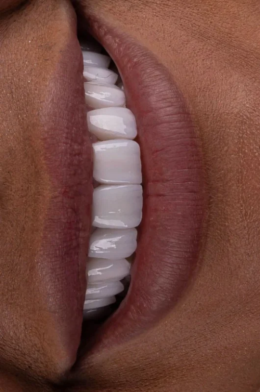 Resultado natural de tratamiento con carillas dentales
