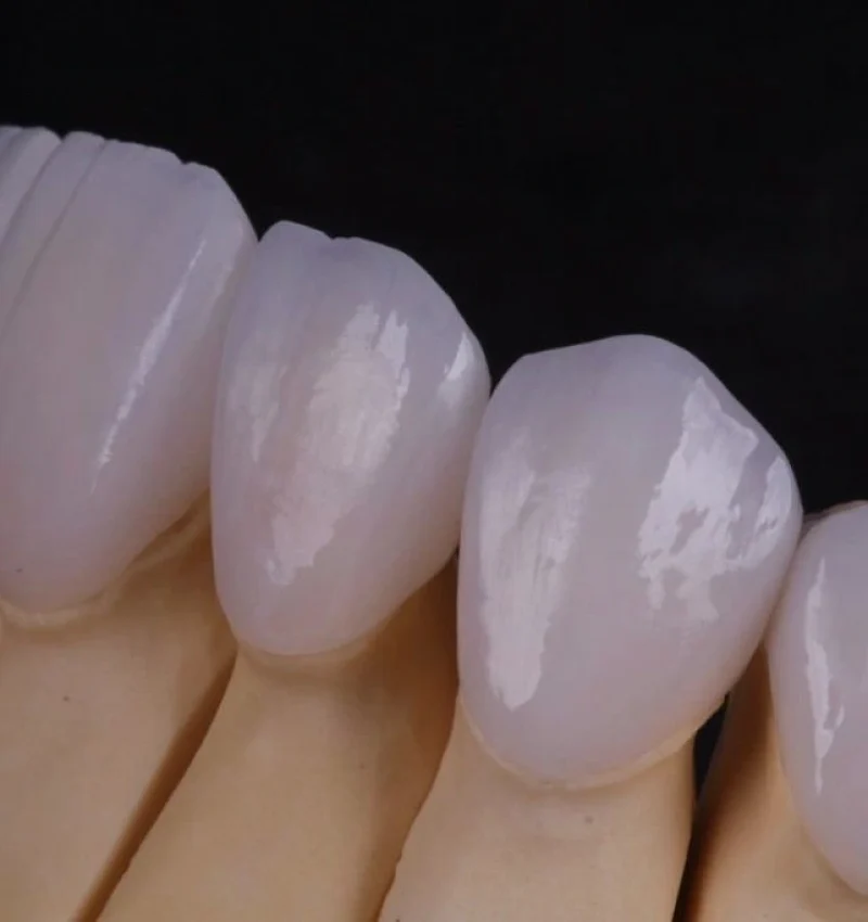 Detalle de carillas de porcelana con textura y translucidez natural