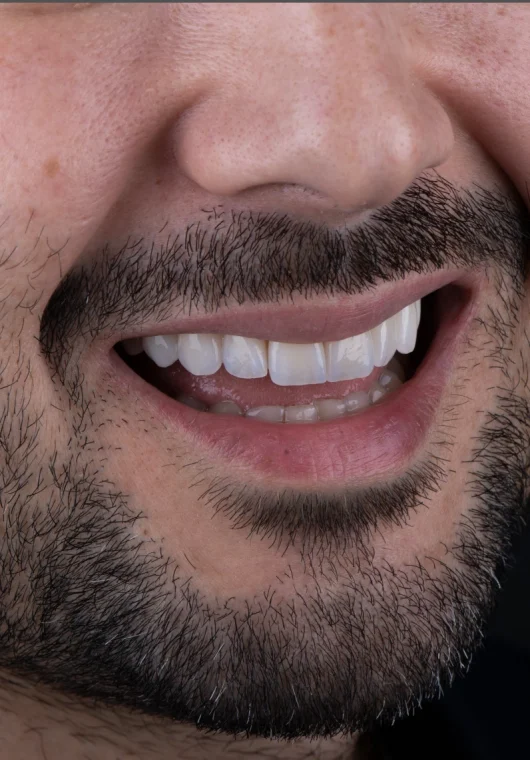 Resultado del diseño de sonrisa con carillas dentales