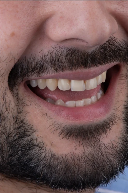 Antes del tratamiento de diseño de sonrisa con carillas dentales